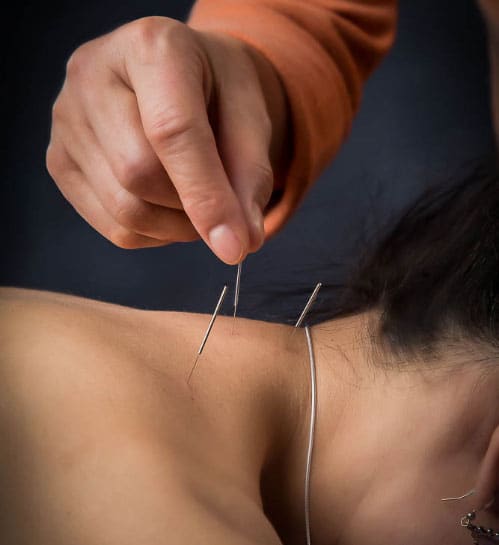 Acupuncture Image 2